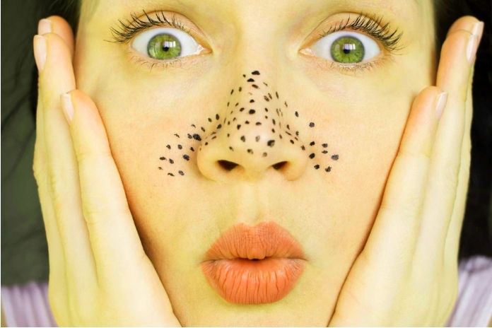 Blackheads Put An End To Black Dots!