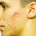 Get Rid Of Pimples Quickly.