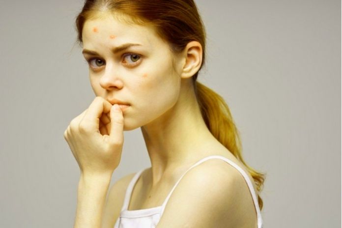 Acne, What Causes It, And How To Treat It