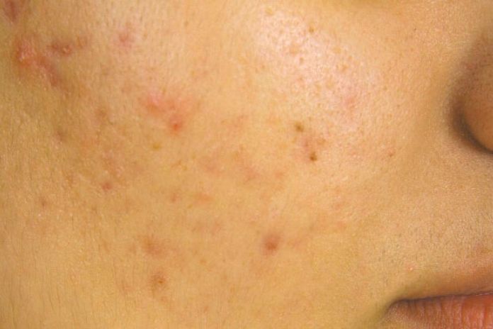 how-pimple-marks-appear-and-quickly-disappear