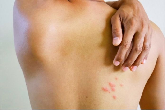 Shingles Symptoms And Causes Of Herpes Zoster