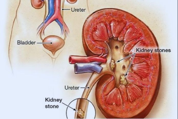Kidney Stones How They Form And Its Symptoms