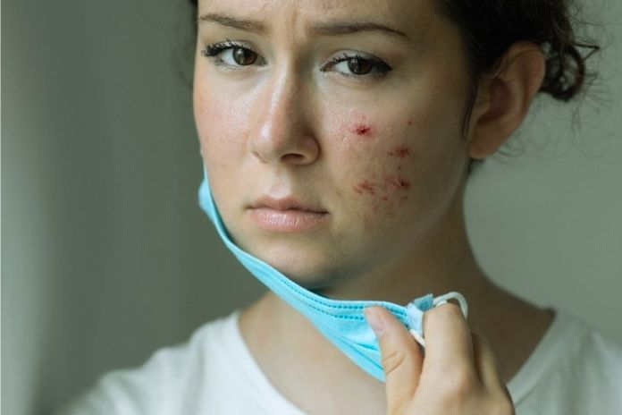 Mask Acne What Is It