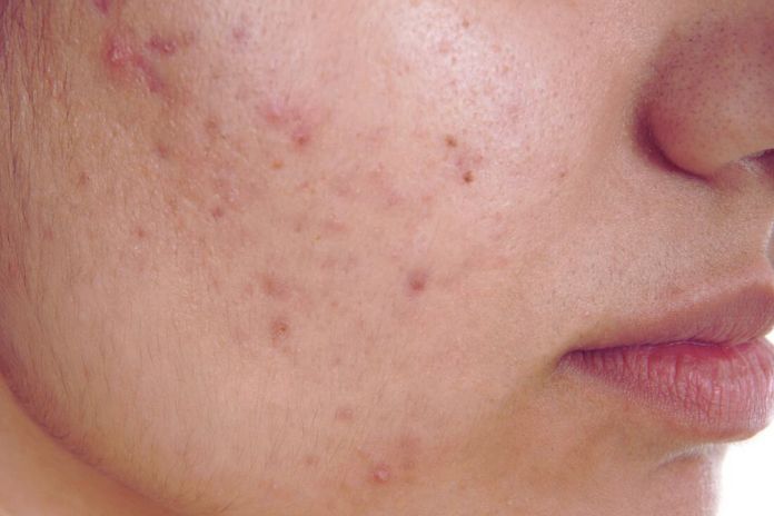 SOS Acne How To Get Rid Of Pimple Marks